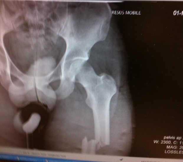 An x-ray of the broken leg